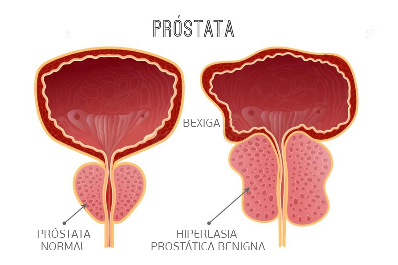 Ultrassom da próstata